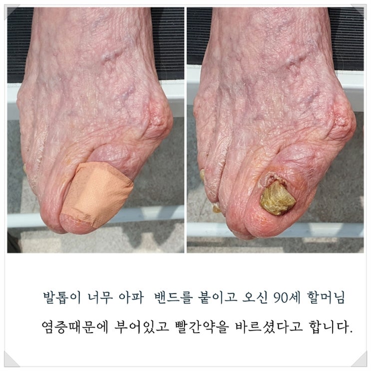 90세 할머니의 역대급 육아종 염증발톱 관리후기/성남수원수지보정동백죽전동/주네일푸스케어용인수지점/무좀발톱염증파고드는내향성발톱손톱변형전문점