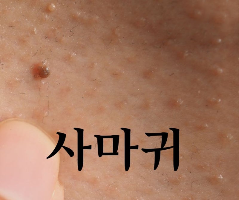부산 사마귀제거 올바른 치료방법