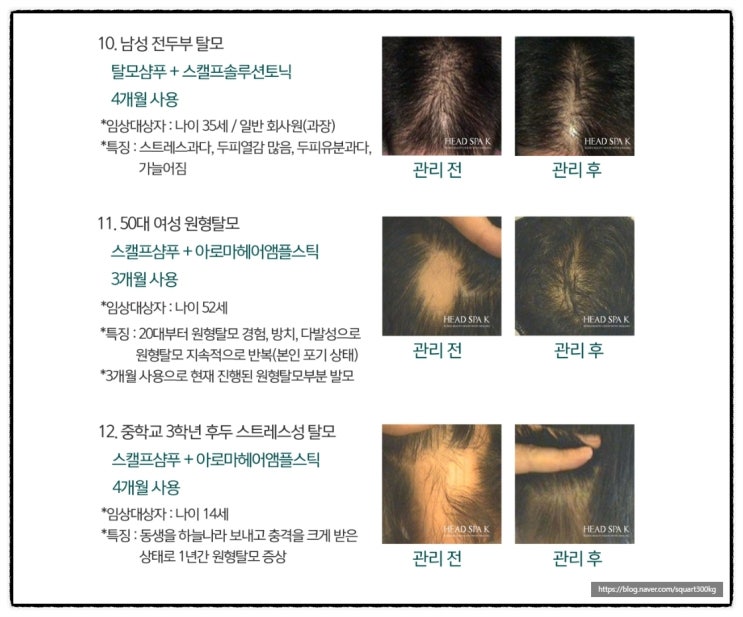  중동탈모? 관리 잘못하면 대머리 됩니다