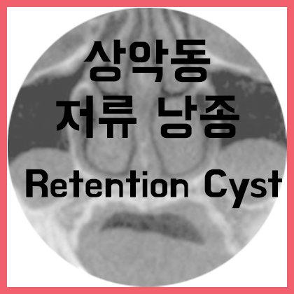  [코] 상악동 저류 낭종(Retention cyst)