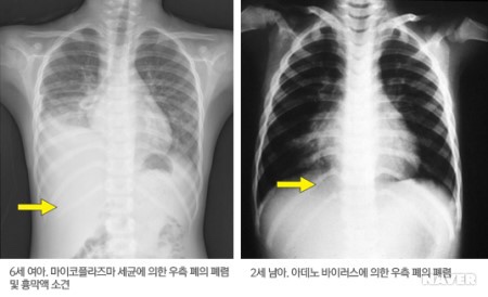  감기, 독감이 아닌 폐렴으로 입원한 아기 금방 나을 수 있을까요?!_폐렴 A to Z,