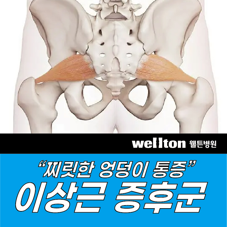  이상근증후군 운동과 도수치료 : 엉덩이 통증 완화하려면