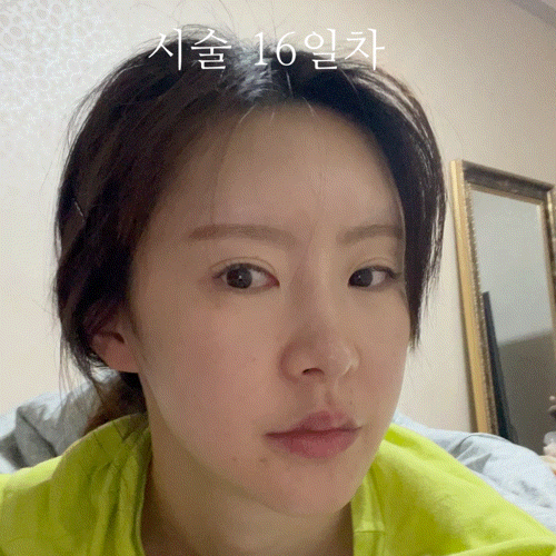  내돈내산 올리지오 300샷 2주차 솔직한 후기 : 올리지오 효과? 기대가 너무 컸어