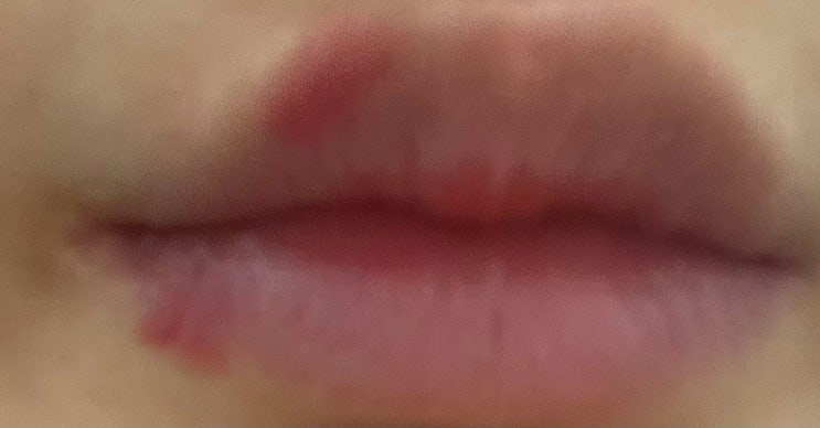  두세달에 한번꼴로 안녕하는 입술포진
