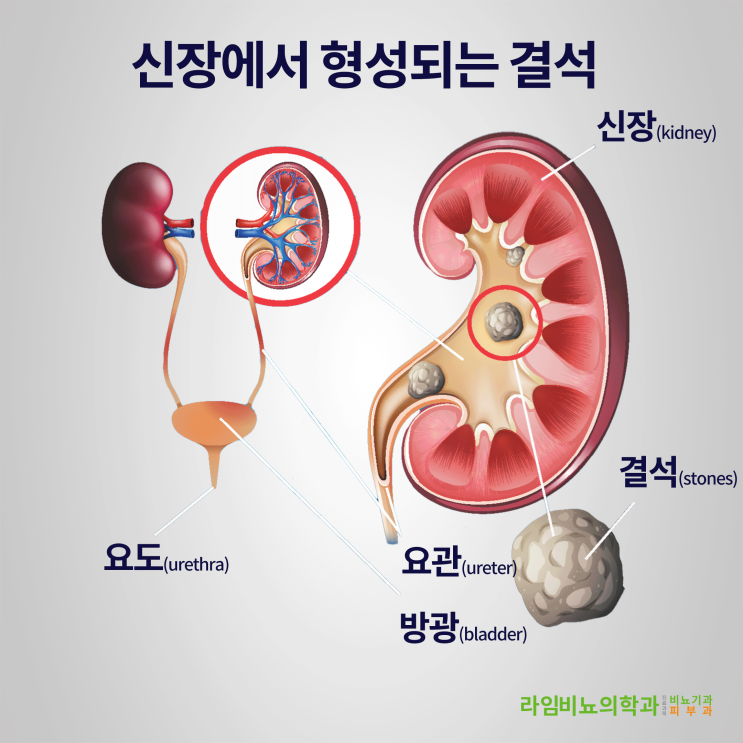  요로결석 시리즈 - 1st, 대구 동구 라임 비뇨기과에서 요로결석에 대해 알아볼까요?