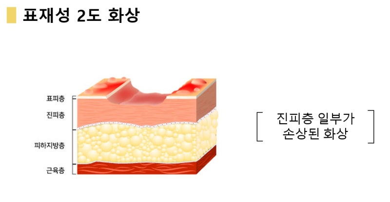 1도 2도 3도 화상의 구분과 회복 과정, 화상단계 : 네이버 블로그