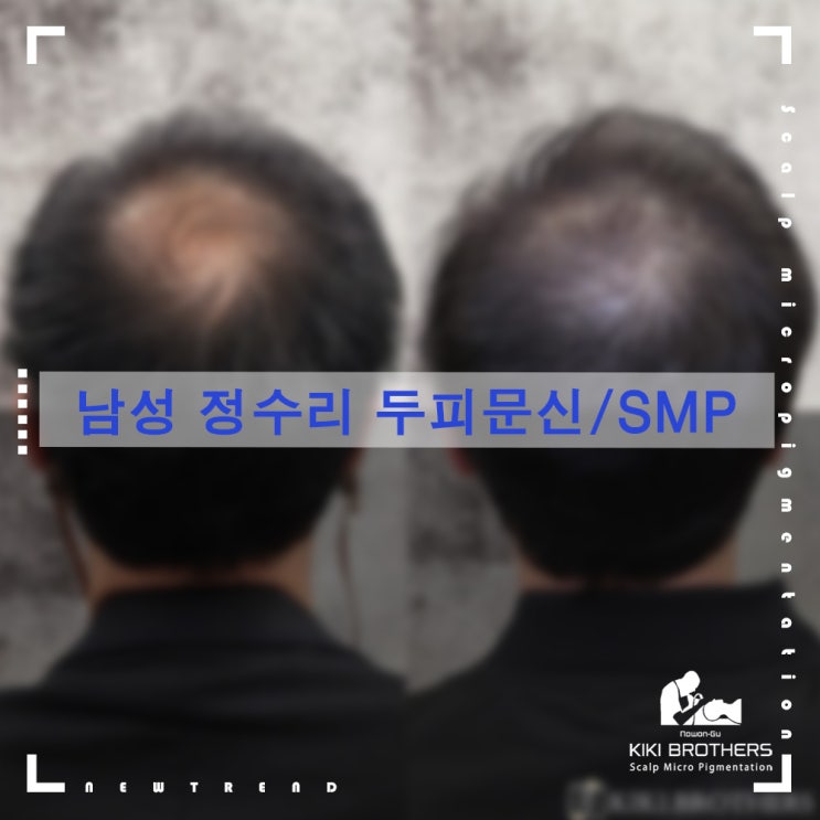 정수리 탈모, 모발이식이 어렵다면 SMP로 커버하자!! 두피문신/SMP 전문점 키키브라더스 노원
