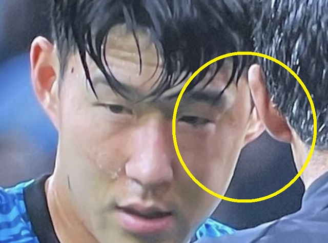  손흥민 결국 골절상 수술.. 월드컵 어쩌나? (카타르 가는 지인도 비상)