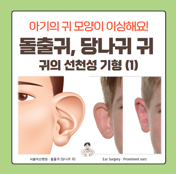  귀의 선천성 기형 (1) - 돌출귀, 당나귀 귀(Protruding ear, Prominent ear)