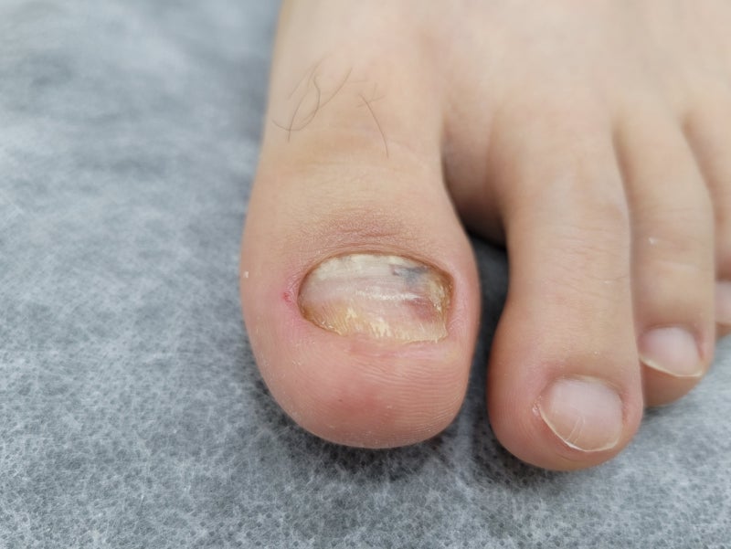 건대발톱무좀, 매니큐어퀸 레푸스 건대점에서 발톱무좀 케어