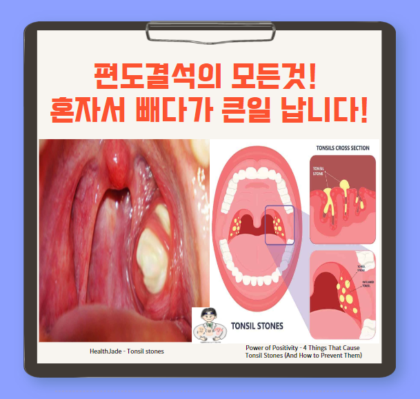  편도결석(Tonsillolith)의 모든것! 혼자서 빼다가 큰일 납니다!