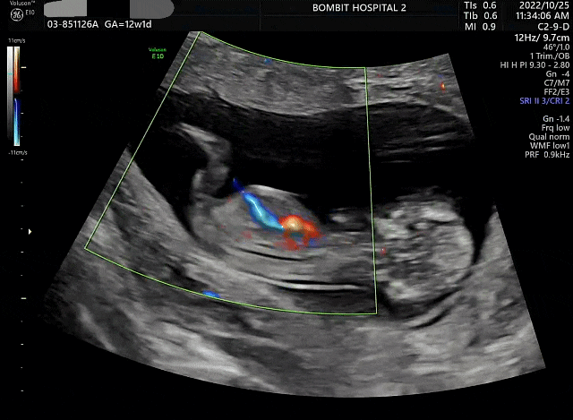 남편의 육아일기 임신 12주 차 - 입체초음파와 1차 기형아검사