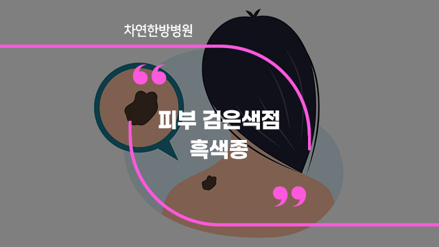  피부 검은점 비슷한 흑색종 피부암일 수도