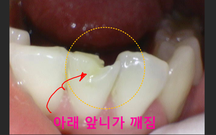  하남 황산사거리 치과 아래앞니가 깨진 것을 레진으로 치료