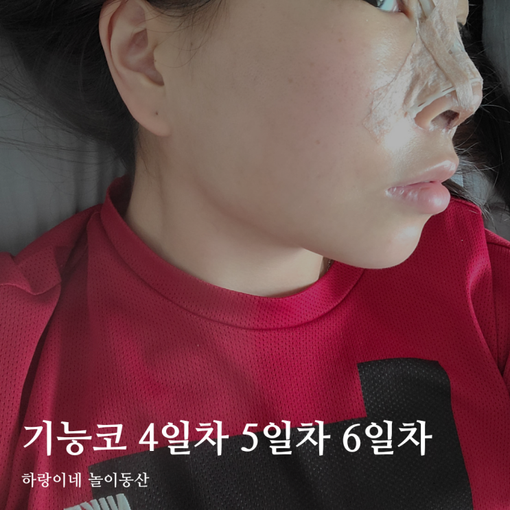  코성형 4일차 5일차 6일차 통증 붓기