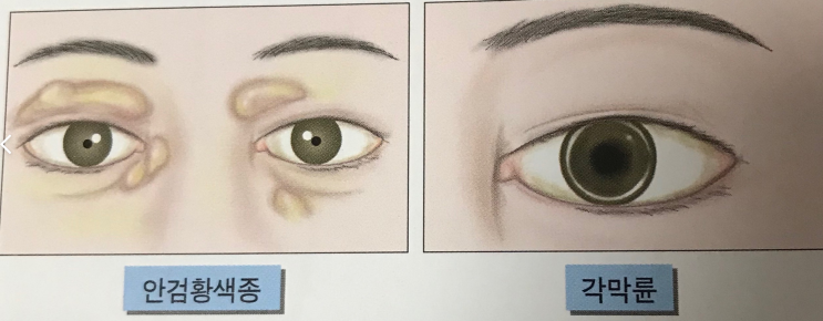  지질이상증 (고지혈증, hyperlipidemia)