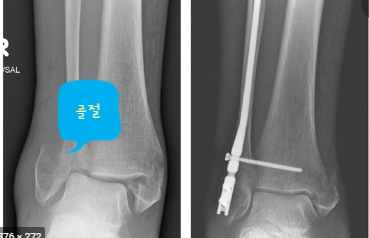 [서면 한의원, 정형외과] 발목 삐었는데 너무 아파요. 골절일까요?