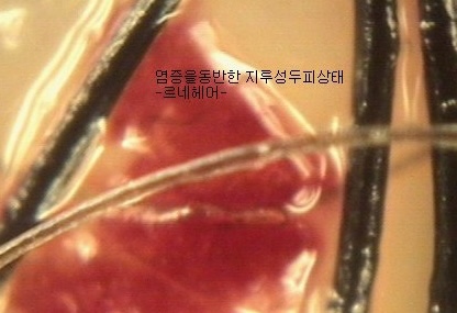  복구클리닉과 탈모관리 잘부탁합니다 오늘부터관리시작 르네헤어/망미연산수영동래사직민락용호울산양산명지대동김해창원마산밀양거제밀양대구구미경남경북전라통영진해사천진주하동내동외동주촌해운대광안리