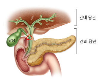 ERCP 부작용 ERCP 4번한 사람& 담관에 6개월간 금속 스텐트 삽관 후기(내시경적 역행성 담췌관 ....