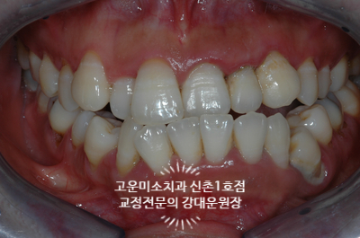  주걱턱 입술돌출 비대칭 잇몸질환을 다 가진 치료증례 신촌치과 고운미소신촌1호점증례