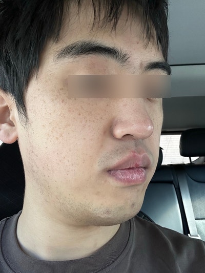 순천 연세이동훈피부과 첫 레이저토닝 후기 기미 주근깨 잡티