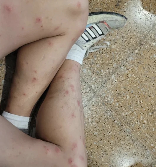 기안84 나이, 남미 여행중 흡혈 곤충 샌드 플라이에 물려 다리 가득 상처
