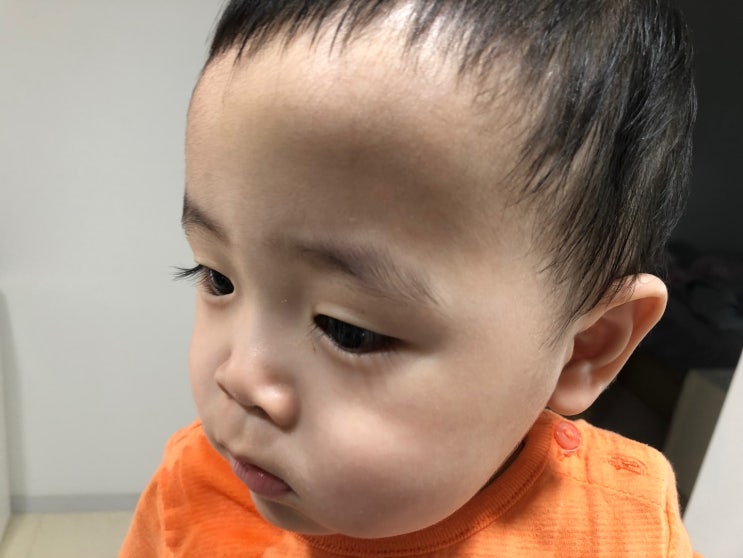  아기 낙상사고 이마 혹과 피고임, X-ray 찍었어요.