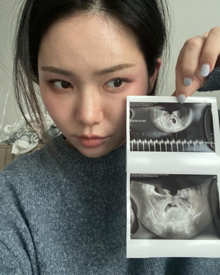 3개월 만에 임신한 유튜버 꽁지, "아직 안 된다고" 또 둘째 임신...갑작스런 소식에 '스윗'한 면모 보인 남편 3개월 만에 임신한 유튜버 꽁지, "아직 안 된다고" 또 둘째 임신...갑작스런 소식에 '스윗'한 면모 보인 남편