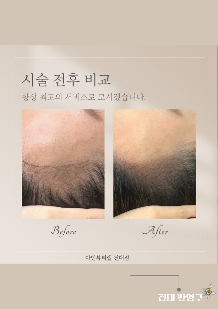  건대두피문신 건대반영구 헤어라인 꽉꽉채우기 어떤가요?