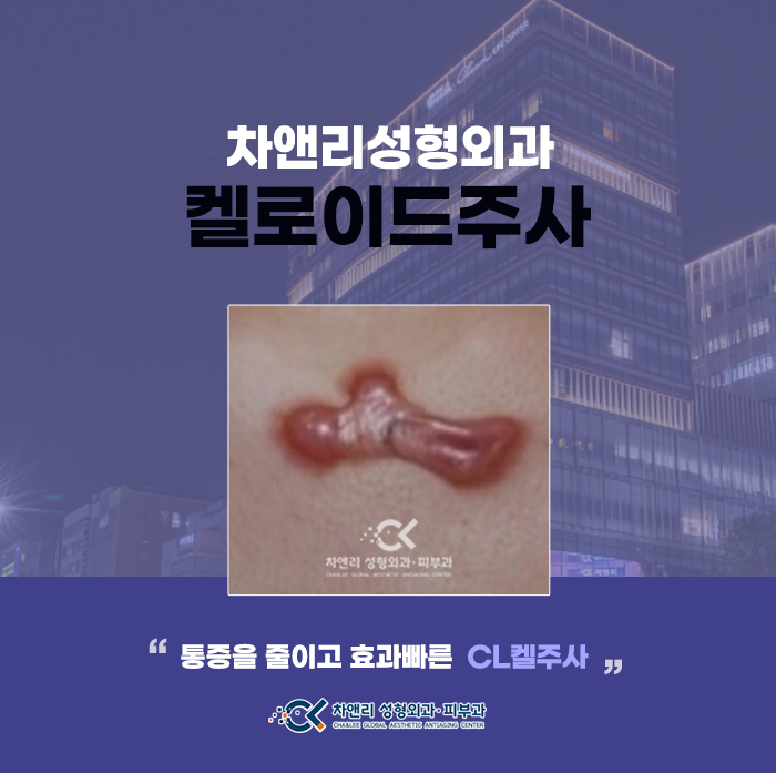  켈로이드흉터, 주사치료부터 제거에서 완치까지