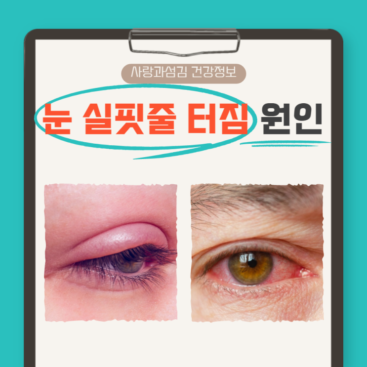 눈 혈관 터짐 원인 결막하출혈 예방법 및 치료법 알아봐요 눈 혈관 터짐 원인 결막하출혈 예방법 및 치료법 알아봐요
