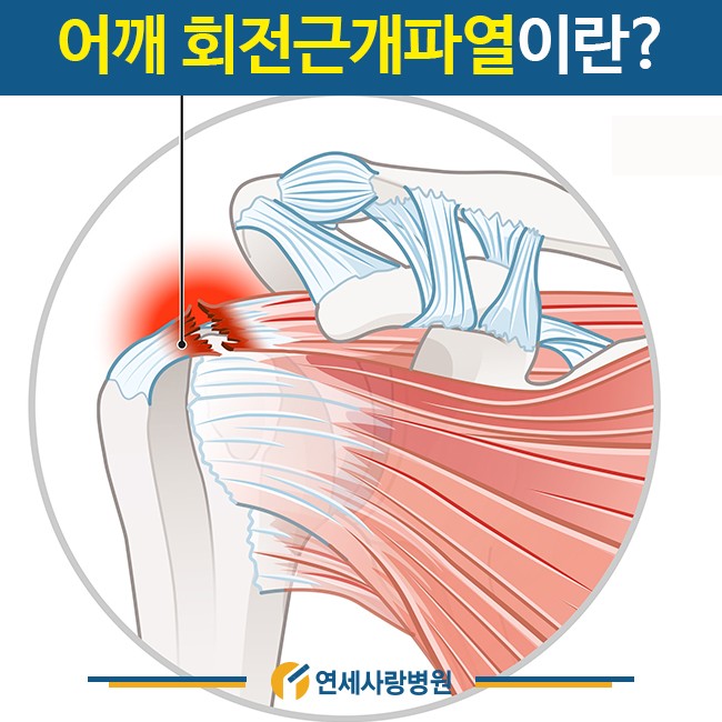 오른쪽 어깨 통증 원인