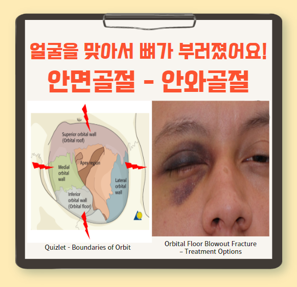  안면골절 (2) - 안와골절(Orbital wall fracture)