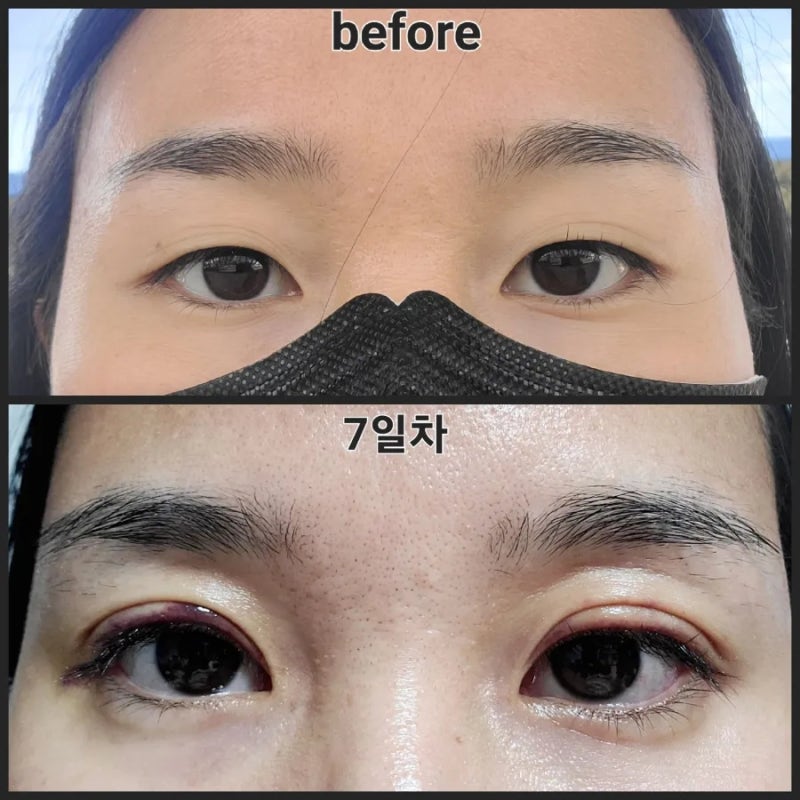 [쌍꺼풀 수술후기]쌍수 관리법!(항생제, 소독, 안연고, 찜질, 세안, 머리감기, 호박즙 등) : 네이버 블로그