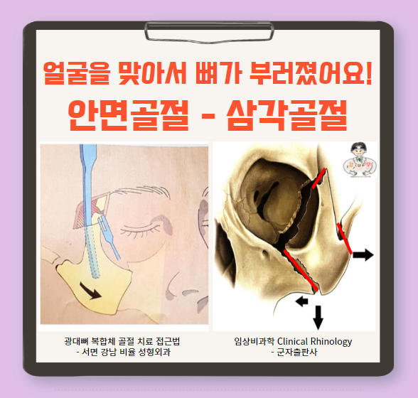  안면골절 (1) - 삼각골절(Tripod fracture)