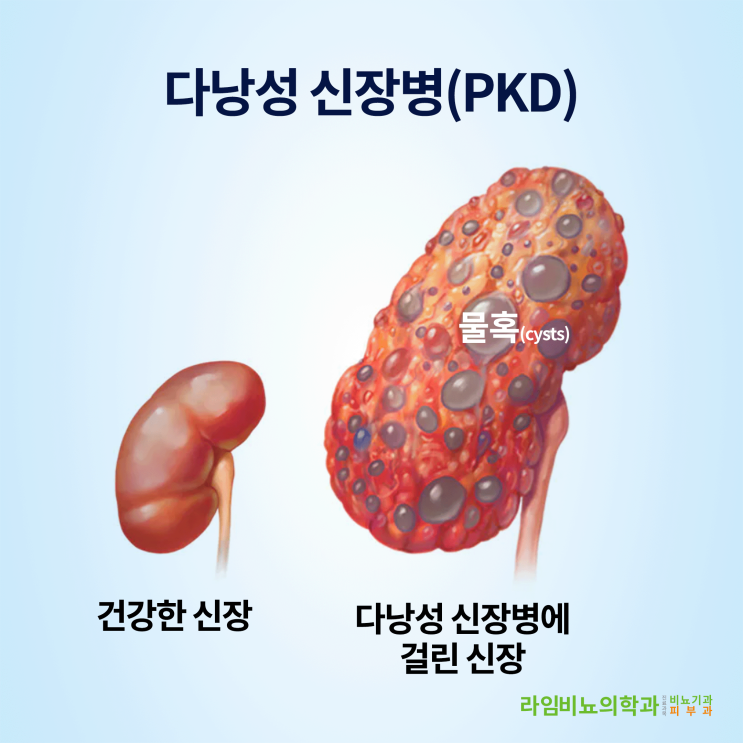 대구동구라임비뇨기과에서 알려드리는 오른쪽 신장 통증 시리즈 - 두 번째 - 다낭성 신장병(PKD)