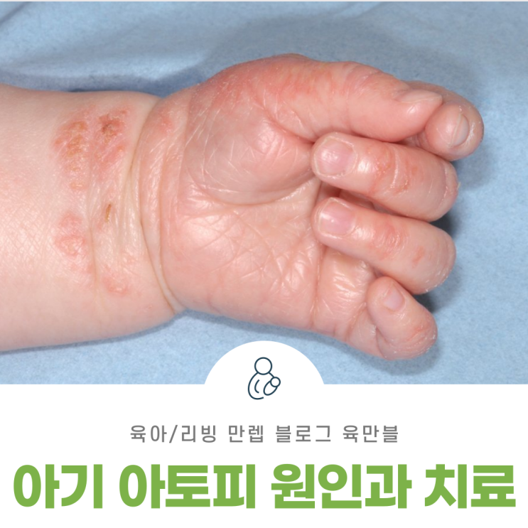  아기아토피원인과치료 우리 아이 피부를 위해