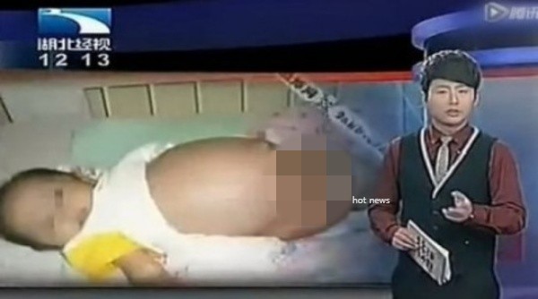 인도 태어난지 21일된 갓난 아기 배 속에서 태아 8명 발견 기생태아에 충격