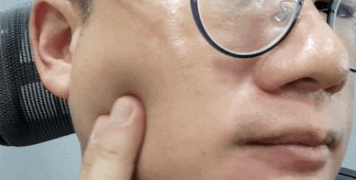  [삼성중앙역피부과] 브이올렛주사 - 이중턱을 넘어 볼살(심술보)까지