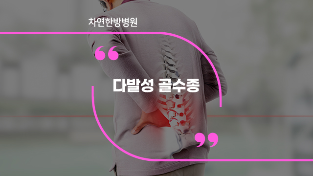  다발성골수종 노인층에서 위험성 높여