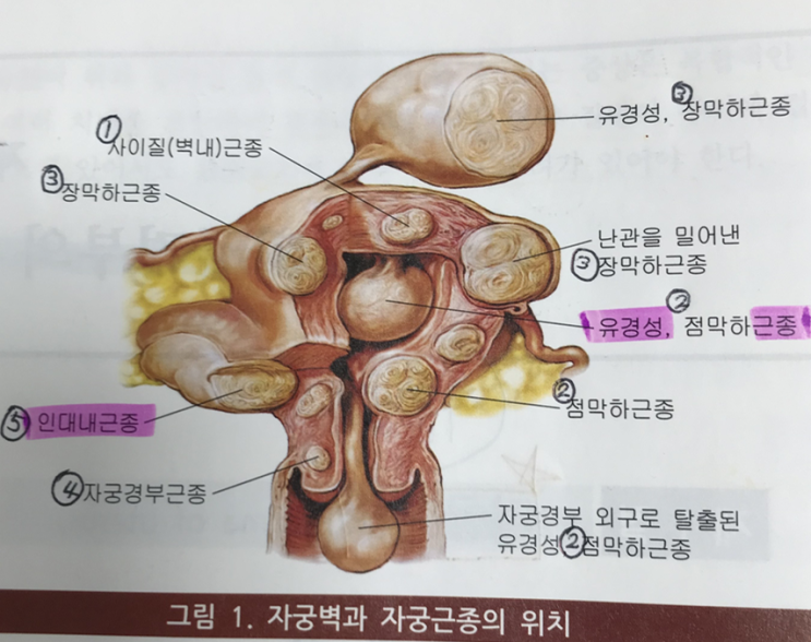  자궁근종 Myoma of uterus = uterine fibroid = leiomyomata