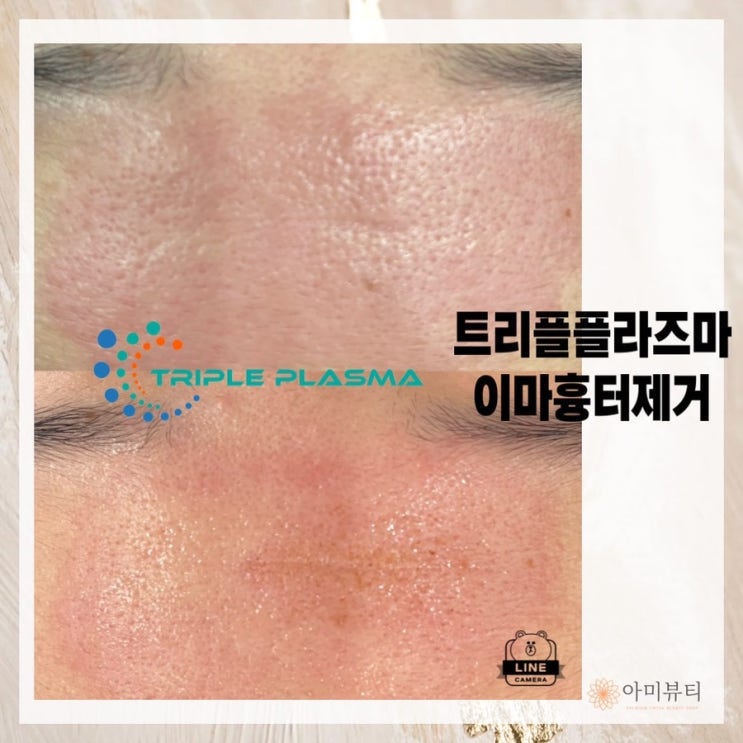 [남대구플라즈마블라스트 지사 아미뷰티] 트리플플라즈마 흉터 제거 대구최초입점
