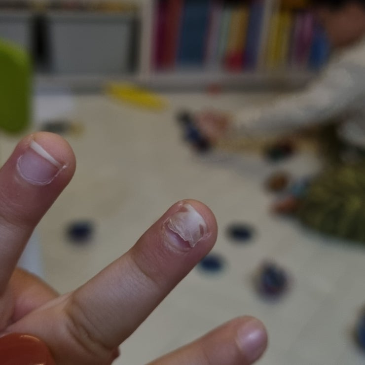 수족구와 구내염 증상, 한 달 후 손발톱 빠짐과 후유증. 수족구와 구내염 증상, 한 달 후 손발톱 빠짐과 후유증.