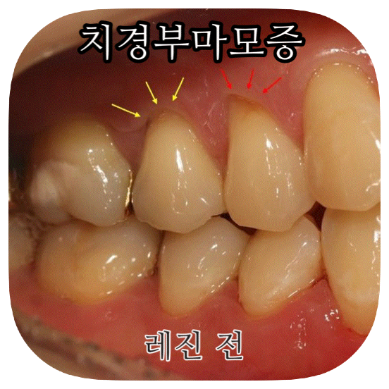  잇몸 시림 파임 혹시 치경부 마모증 아닌가요?
