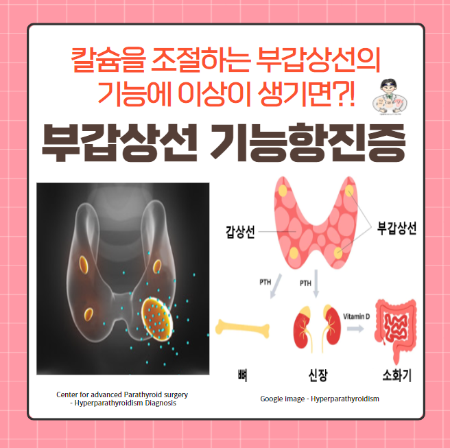  부갑상선(Parathyroid gland) 질환 (1) - 부갑상선 기능항진증(Hyperparathyroidism)