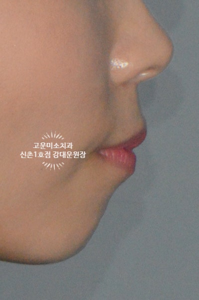  돌출입 2급부정교합 무턱 뚱한 입술을 치료하고 싶은 환자분 신촌교정치과 고운미소치과 신촌1호점 증례