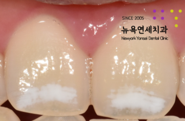  [강남역치과]반점치 또는 화이트스팟 치아미백으로 해결할 수 있나요?
