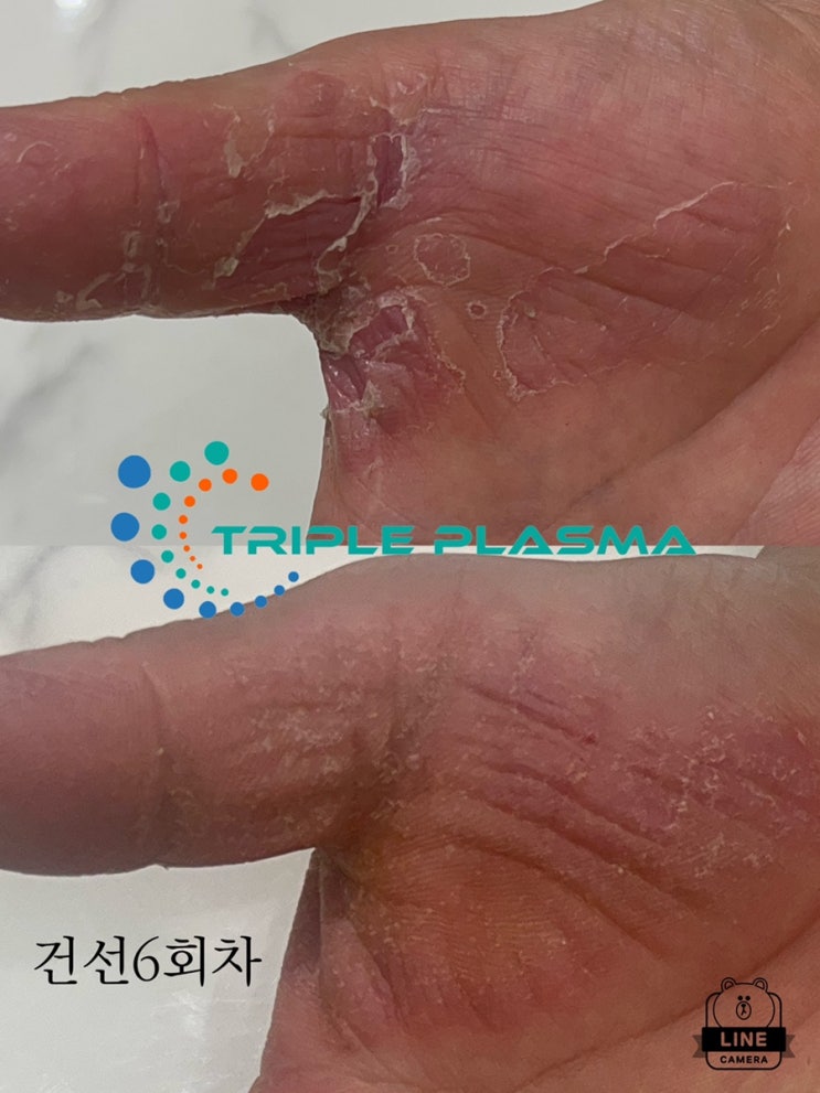  [대구  메디컬스킨케어     아미뷰티] 손전체 악성 건선 뭘해도낫지않은 손건선! 트리플플라즈마 콜드플라즈마 샤워로 해결됐어요