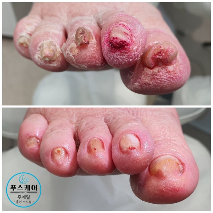 14후퇴때 피난내려오면서 동상에 걸린후 변형되어버린 할머니발톱 너무아파서 걸을수가 없어요./성남수원수지보정동백죽전동/주네일푸스케어용인수지점/파고드는무좀내성발톱변형전문점 14후퇴때 피난내려오면서 동상에 걸린후 변형되어버린 할머니발톱 너무아파서 걸을수가 없어요./성남수원수지보정동백죽전동/주네일푸스케어용인수지점/파고드는무좀내성발톱변형전문점