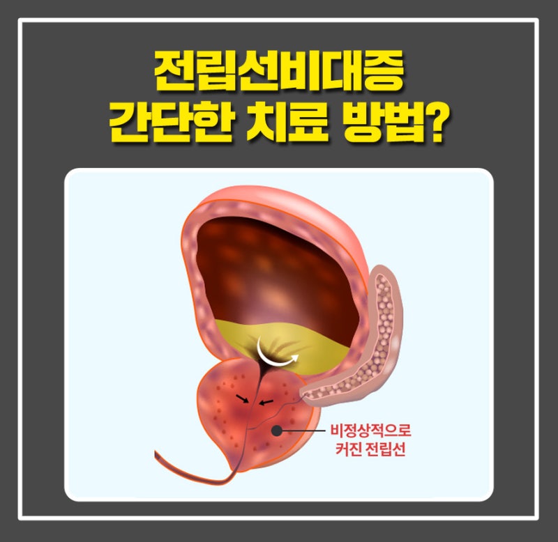 부산전립선치료는 어떻게? 5